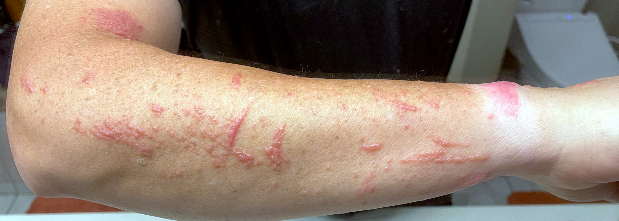 My arm covered in red blisters